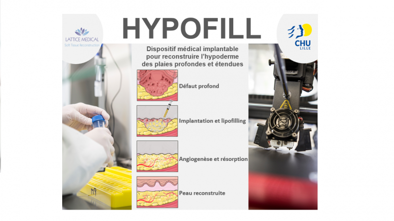 HYPOFILL : dispositif médical implantable pour reconstruire l'hypoderme
